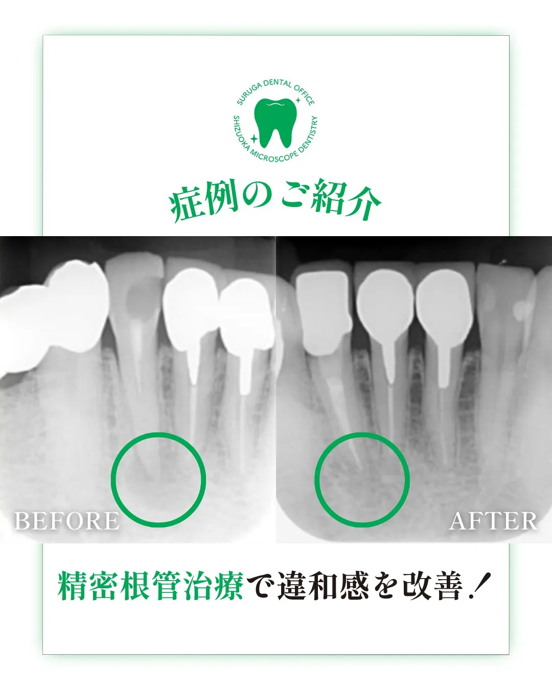 根管治療の症例