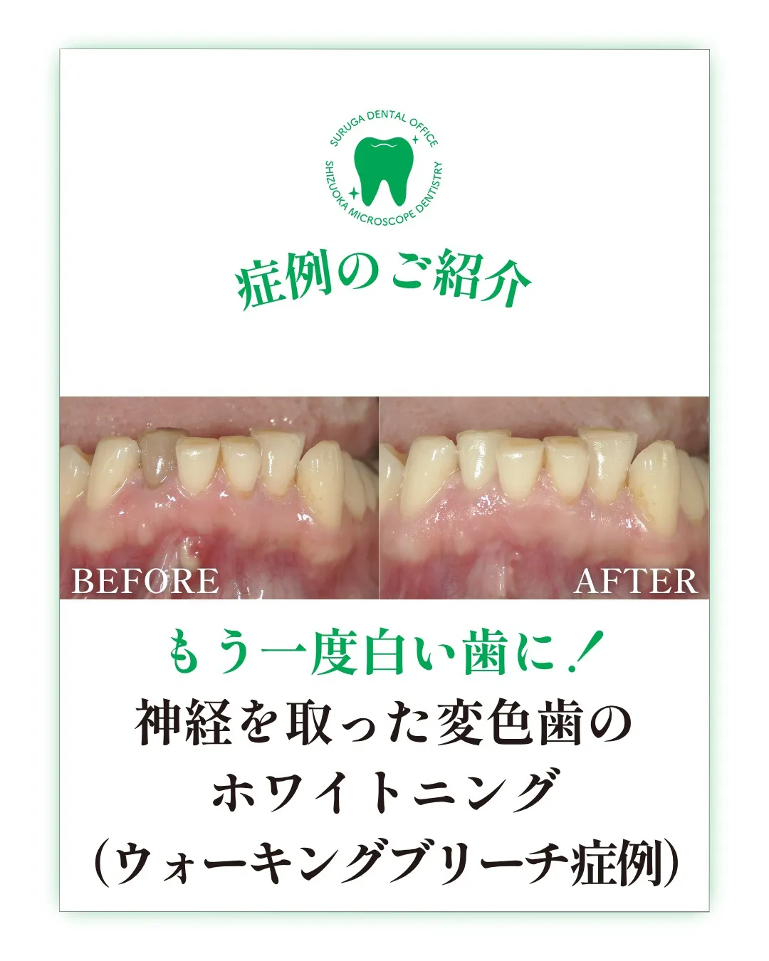 ウォーキングブリーチの症例