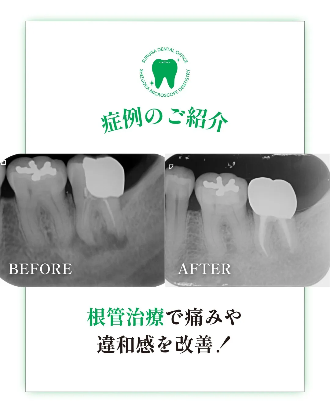 根管治療の症例