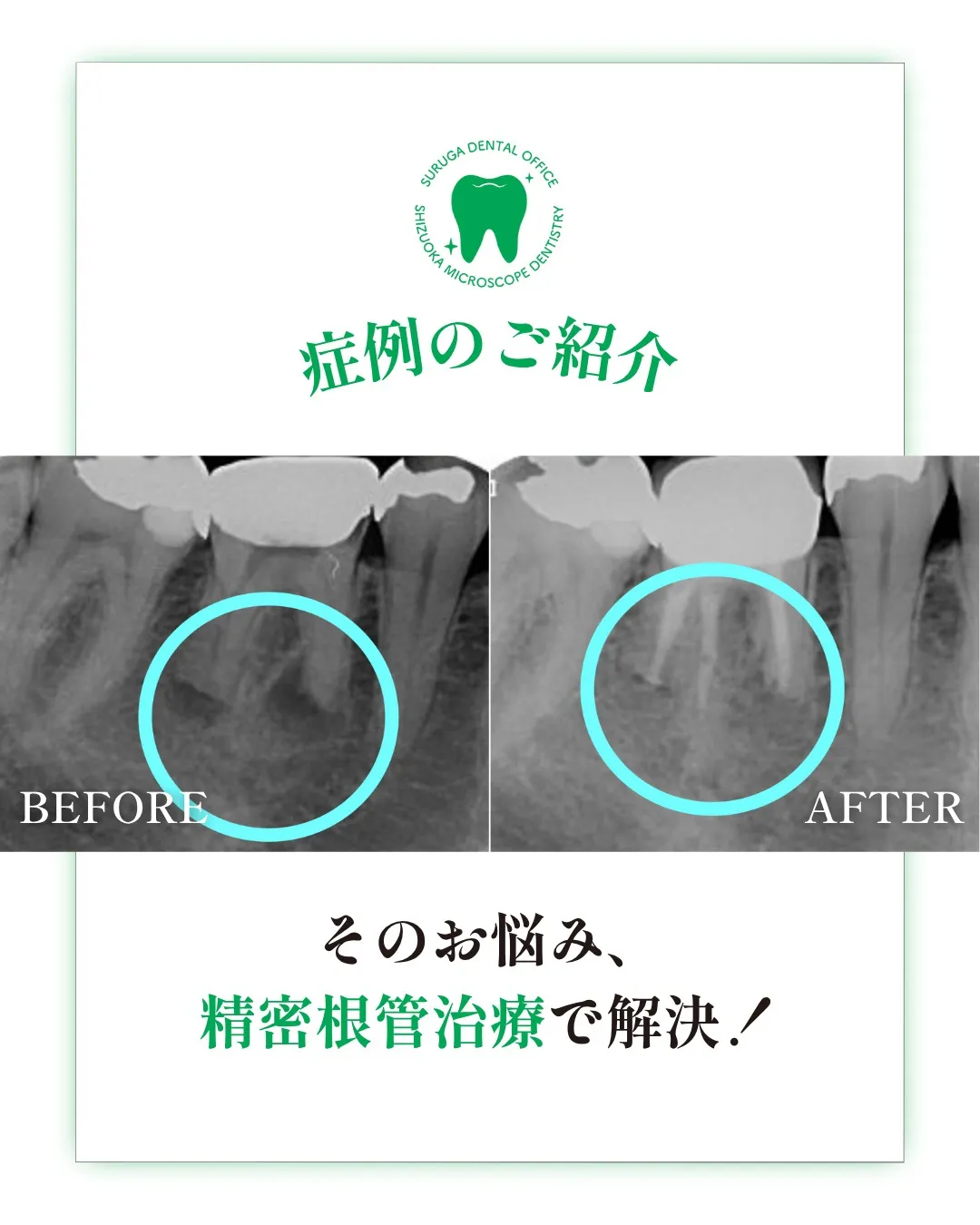 根管治療の症例