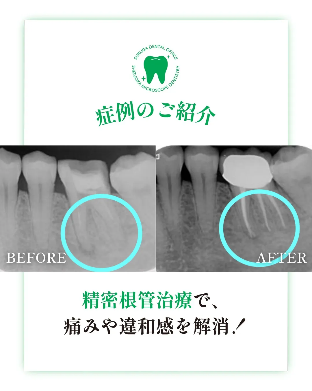 根管治療の症例