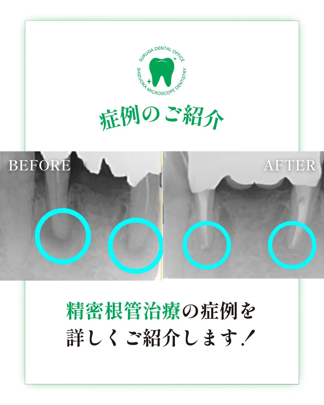 根管治療の症例