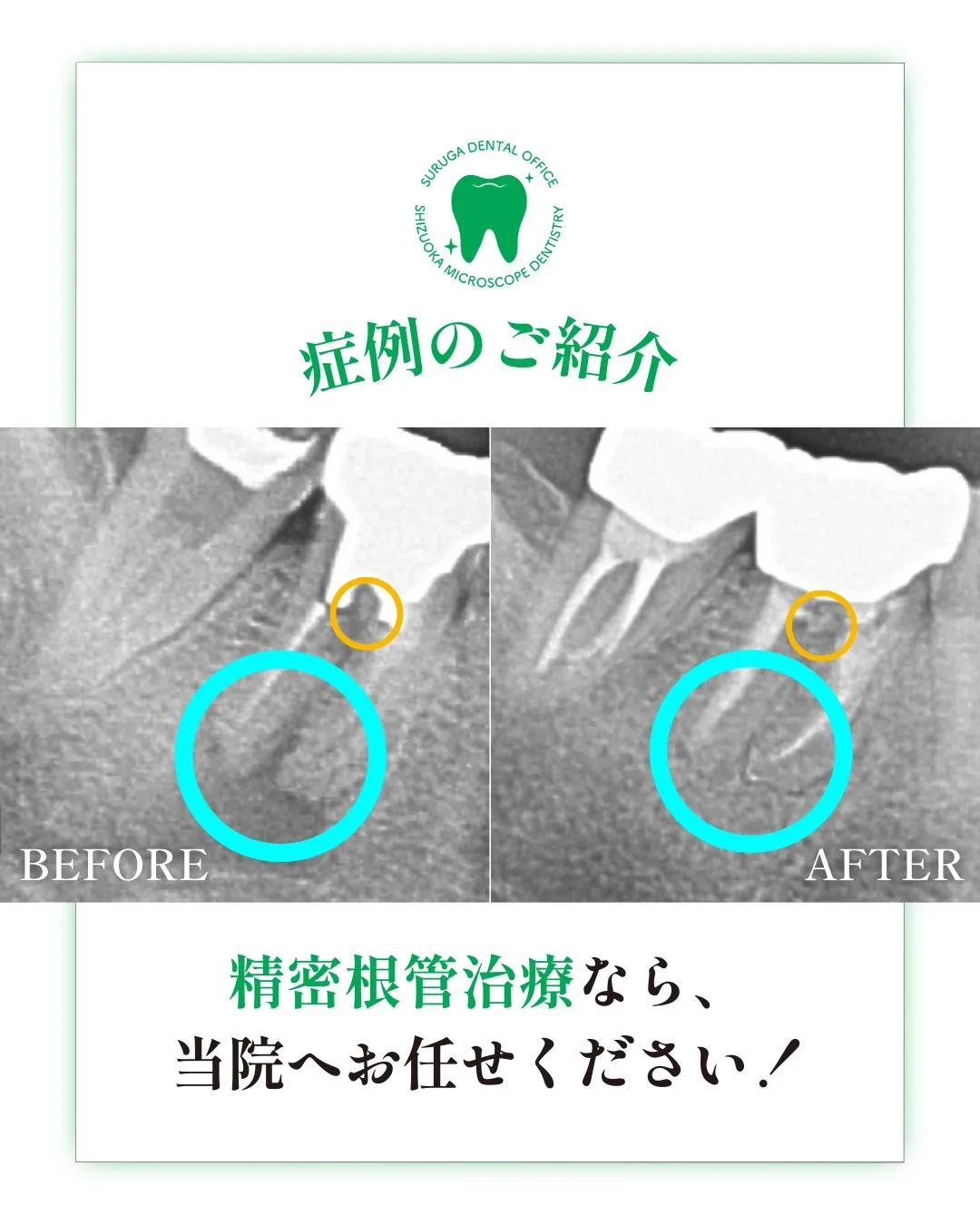 根管治療の症例