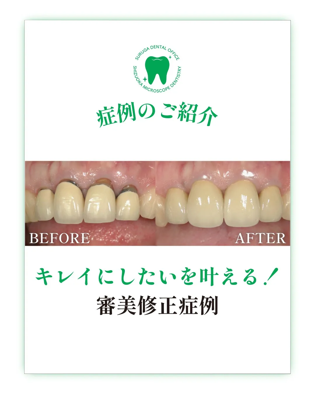 前歯部 審美修復症例