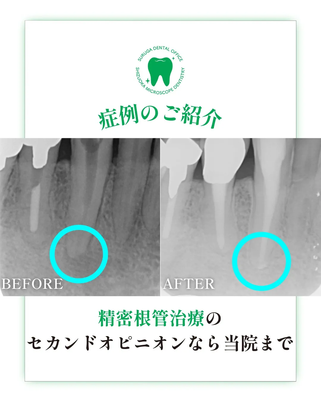 根管治療の症例