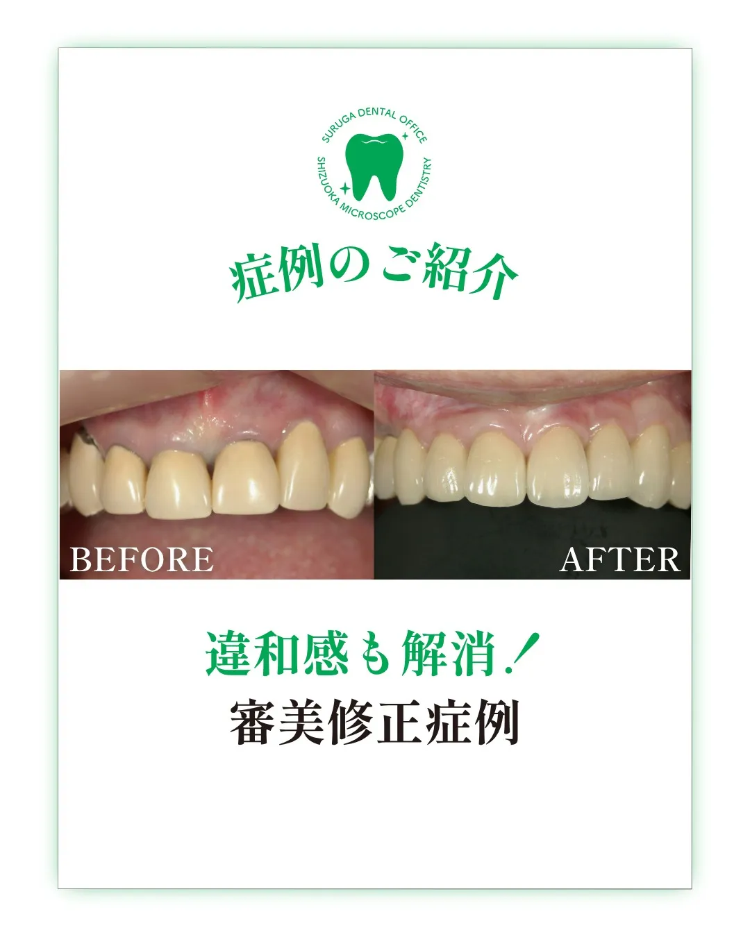 前歯部審美修復症例