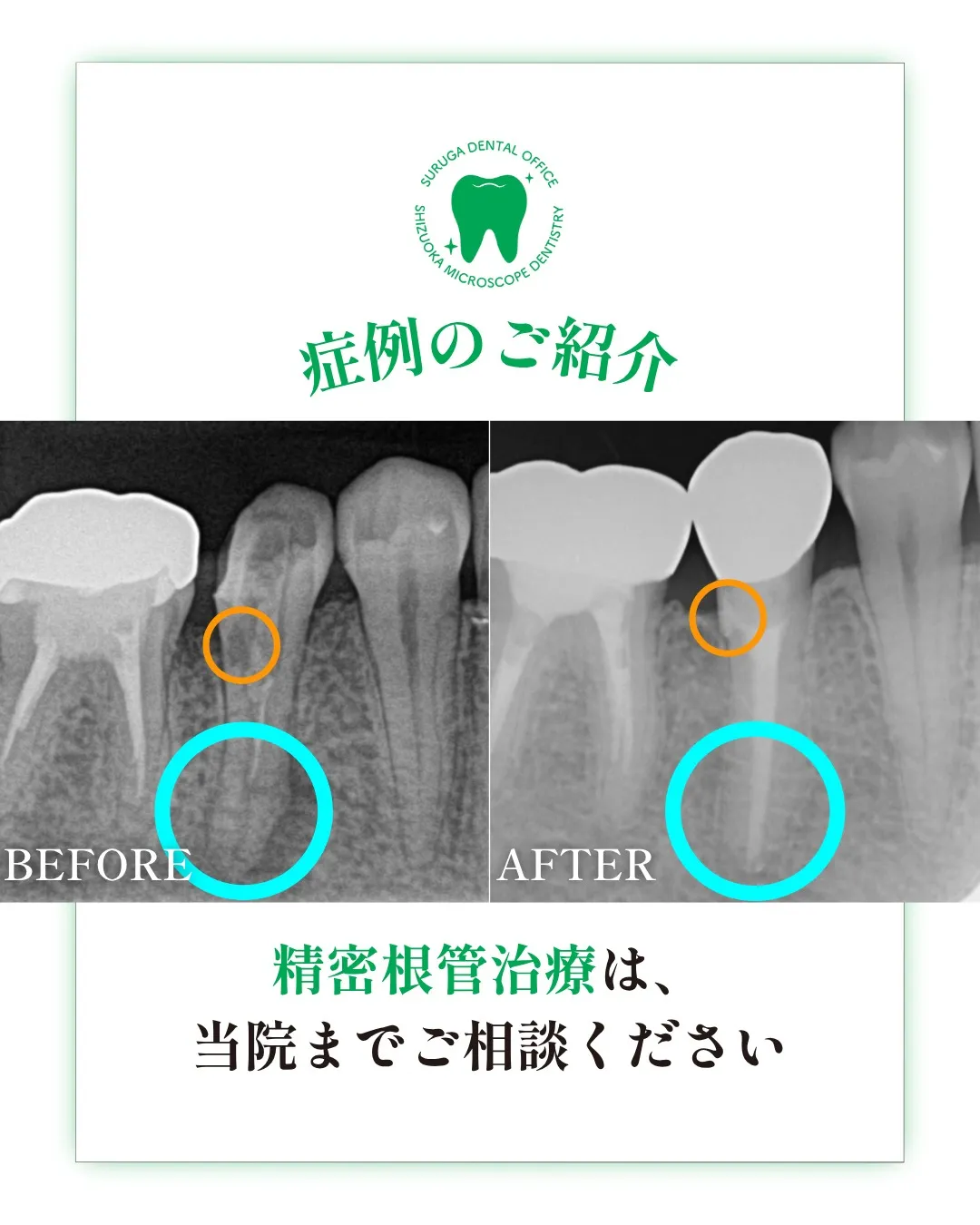 根管治療の症例