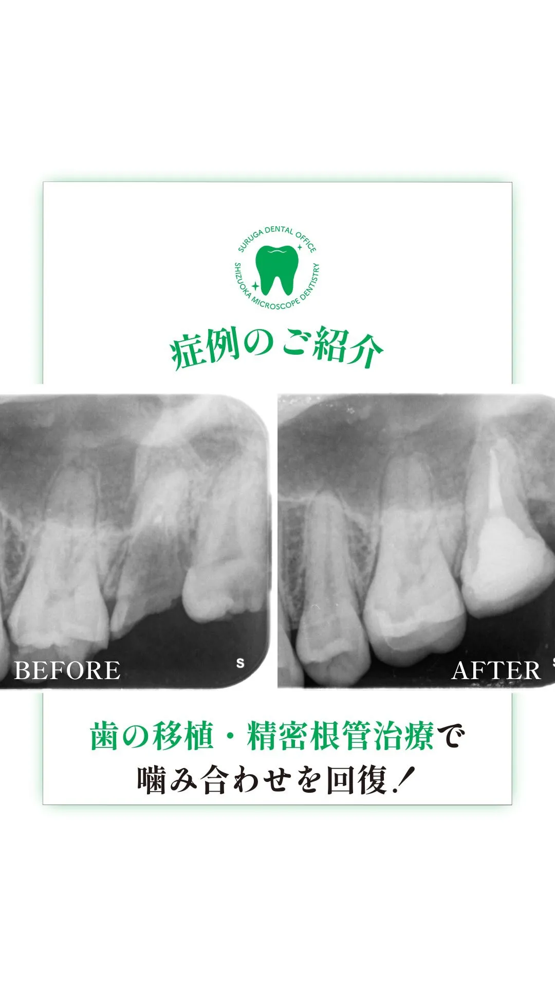 歯の移植・根管治療の症例